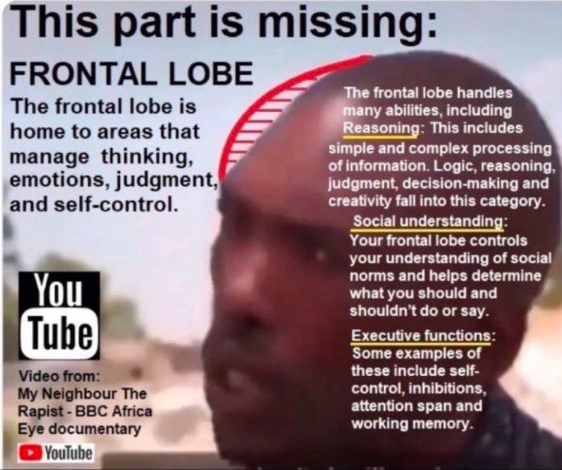 This part is missing FRONTAL LOBE frontal lobe handles The frontal lobe is abilities, including home to areas that This includes manage thinking, simple and complex processing of information. Logic, r