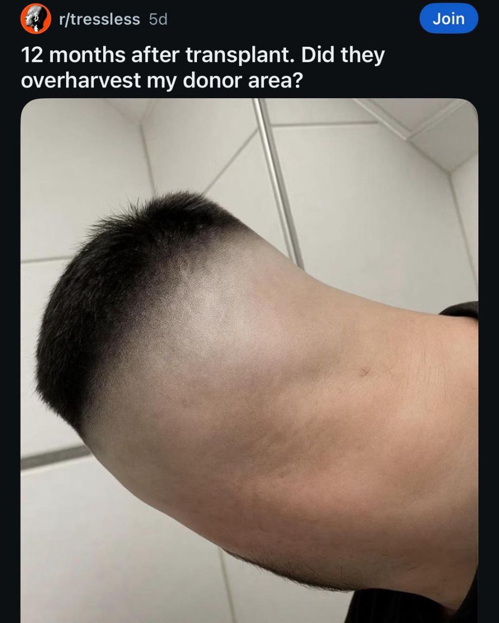 Join r/tressless 12 months after transplant. Did they overharvest my donor area?