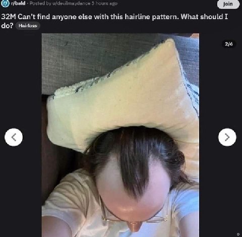 Posted u/devilmaydance 3 У а а Can’t find anyone else with this hairline pattern. What should I Hairloss 2/6